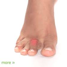 Bone spurs usually can't be prevented if they're the result of the natural harvard medical school: Foot Pain Causes Diagnosis Prevention And Treatment