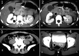 Radiology In Ped Emerg Med Vol 7 Case 5