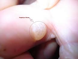 Check spelling or type a new query. Neem For Pompholyx Dyshidrotic Eczema Vesicular Eczema Posts Facebook