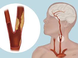 Carotid artery disease is a disease in which a waxy substance called plaque builds up inside the carotid arteries. Procedure To Open Blocked Carotid Arteries Tested Digital Outlook