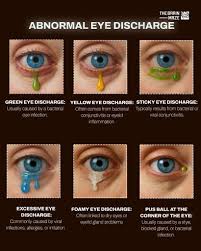 Image result for Eye Discharge