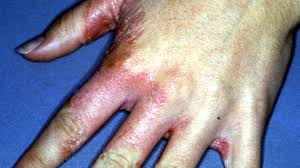 Mix a cleaning solution of 1 part bleach and 10 parts water. Tinea Manuum Causes Symptoms And More