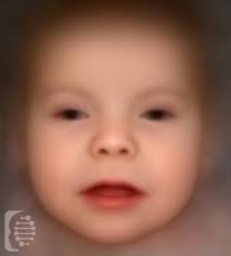 This condition is characterized by extremely weak muscle tone (hypotonia). Pallister Killian Syndrome Understand The Symptoms And Causes