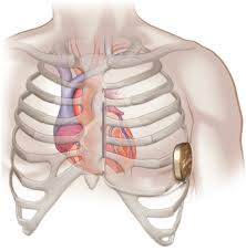 Image result for Internal Cardiac Defibrillator