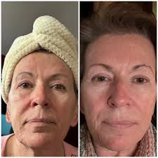 👏Just twelve days in with the Bakuchiol products! This before and after  speak for themselves.! Amazing 🌿