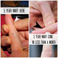 How To Get Rid Of Warts Naturally With One Ingredient Practical Stewardship Get Rid Of Warts How To Get Rid Warts Remedy