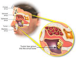 Their tumors can differ in sizes, where they're located, and how distant they are from. What Is Maxillary Sinus Cancer