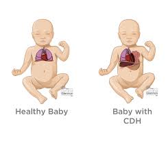 Congenital Diaphragmatic Hernia Cdh About Diagnosis