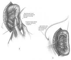 Several techniques of laparoscopic jejunostomy (lj) have been described, yet the witzel approach remains neglected, due to the perceived difficulty of suturing the bowel around the tube and securing them to the abdominal wall. Https Www Sciencedirect Com Science Article Pii S1524153x01800221 Pdf Md5 D4f47e9a1b884ff8e620769e8f4f374f Pid 1 S2 0 S1524153x01800221 Main Pdf Valck 1