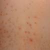 Pityriasis rubra pilaris is a benign, chronic skin disorder in which the skin becomes red, swollen, rough, and dry. 1