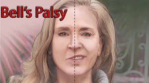 In addition, many of those who develop bell's palsy following. Bell S Palsy Facial Nerve Palsy Youtube