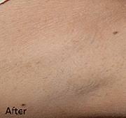 Be the first to add a business to this category in stafford, va or browse best hair removal for more cities. Laser Hair Removal Washington Dermatology Consultants