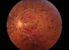 Image result for Hyperviscosity Syndrome