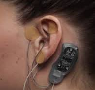 Auricular nerve stimulation using the NSS-2 BRIDGE device to ...