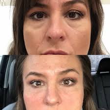 Botox at Be You Medical Spa : Prestonsburg KY : 606-207-8364