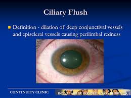 Image result for Ciliary Flush