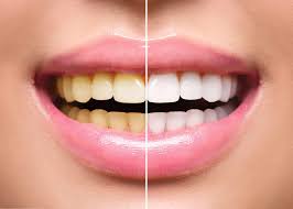 Image result for Tooth Discoloration