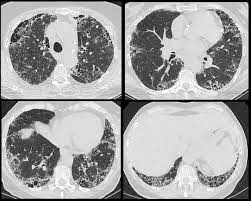 Rheumatoid Arthritis Pulmonary Manifestations Radiology Reference Article Radiopaedia Org