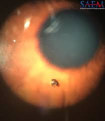 Image result for Eye Foreign Body
