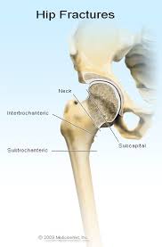 Posted by michael carlson, md | april 26, 2016. Hip Pain Symptoms Treatment Causes Exercises Relief