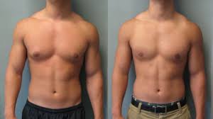Bodybuilding communities call gynecomastia gyno when they talk about it. Best Way To Get Rid Of Gynecomastia Without Surgery Youtube