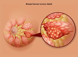 Unlike other breast cancers, inflammatory breast cancer usually does not cause a distinct lump in the breast. Breast Cancer Signs Symptoms Stages Treatment About Risk Factors Ashray