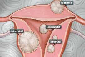 Fibroids are the most common indication for a hysterectomy 7). What Are Uterine Fibroids Symptoms Treatment Pictures