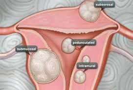 These growths are usually not cancerous (benign). What Are Uterine Fibroids Symptoms Treatment Pictures