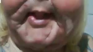 Juju do Pix relata problema em cicatrização após cirurgia para retirada de óleo mineral: 'Ponto acabou abrindo'