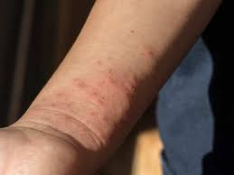 It is our third biggest cancer killer, and yet misunderstandings about the signs and symptoms of this cancer exist. How To Detect Symptoms Of Leukemia At An Early Stage The Times Of India