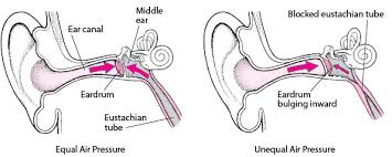 Image result for Inner Ear Decompression Sickness