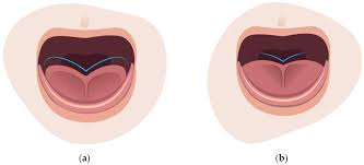 Image result for Ankyloglossia