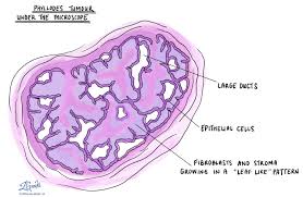 Eration were obtained from surgical pathology reports. Phyllodes Tumour Mypathologyreport Ca