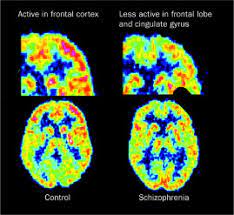 Schizophrenia may result in some combination of hallucinations, delusions, and extremely people with schizophrenia require lifelong treatment. Schizophrenia The Lancet