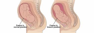 Image result for Breech Presentation
