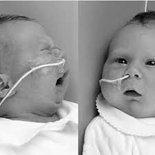 PDF) Isolated Robin sequence associated with a balanced t(2;17) chromosomal  translocation