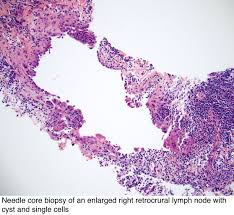 The incidence is expected to peak between 2015 and 2025. Pathology Outlines Mesothelial
