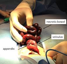 Image result for Intestinal Malrotation