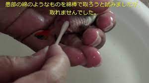 Manage your video collection and share your thoughts. æ²»ç™‚ é‡'é­šã®ç™½é›²ç—… ã‚'æ²»ç™‚ã—ã¦ã¿ãŸ Youtube