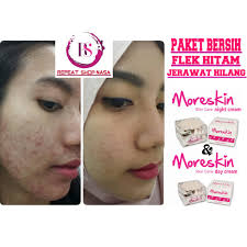 Bekas jerawat berupa flek hitam (atau kemerahan) pada kulit biasanya dikenal dengan istilah post inflammatory hyperpigmentation (pih). Bintik Hitam Wajah Susah Hilang Flek Hitam Bekas Jerawat Penghilang Flek Noda Hitam Bekas Jerawat Shopee Indonesia