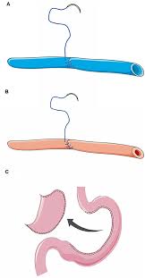 Kevin mckeown regional operations manager / region 6. Frontiers Simultaneous Vascular Reconstruction And Cervical Anastomosis In Mckeown Esophagectomy Surgery