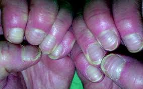 We did not find results for: Deformities Dystrophies And Discoloration Of The Nails Skin Disorders Msd Manual Consumer Version
