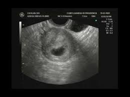 El corazón de tu bebé late casi el doble de rápido que el tuyo. First Ultrasound 4 6 Weeks Primer Ultrasonido 4 6 Semanas Youtube En 2021 Primer Ultrasonido Ultrasonido 12 Semanas De Embarazo