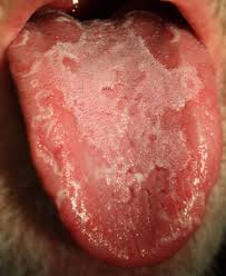 Image result for yellow tongue infection