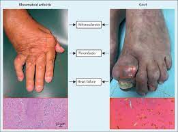 What are symptoms and signs of rheumatoid arthritis? Cardiovascular Risk In Inflammatory Arthritis Rheumatoid Arthritis And Gout The Lancet Rheumatology