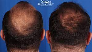 Neograft Hair Restoration To Many A Full Head Of Hair Represents Attractiveness And Desirability Both P Hair Transplantation Hair Transplant Hair Restoration