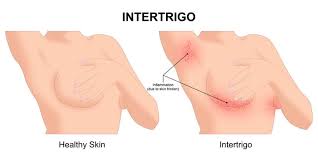 Image result for Intertrigo under breasts