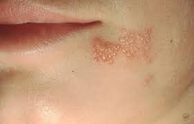 If you want to see the face distance calculated for each match in order. Herpes Simplex Pariser Dermatology