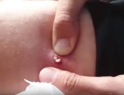 Connect by text or video with a u.s. Infected Ingrown Hair Cyst Archives New Pimple Popping Videos