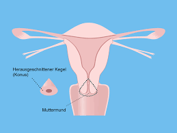 Konisation Curettage